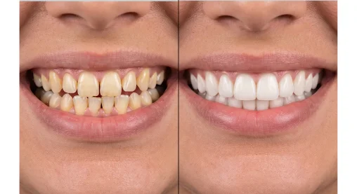 Antes e depois